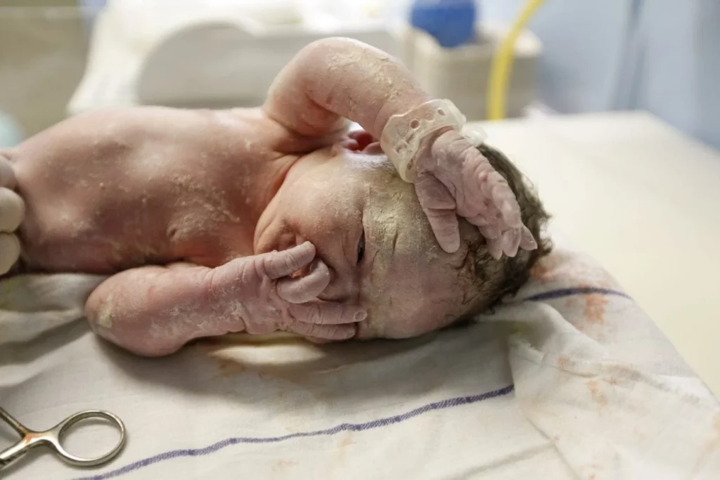 vernix 