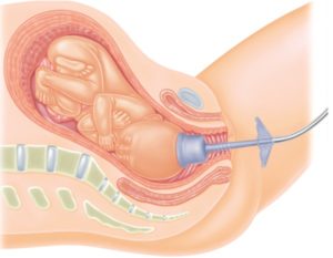 Ventouse accouchement